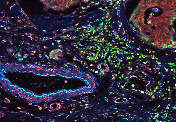 Fluorescent detection of vimentin and lamin IHC B1 in normal colon tissue. Sections of normal human colon cancer tissues were blocked with BSA buffer Thermo Scientific blocking windows before incubation with anti-vimentin antibodies and anti-lamin B1 antibody, followed by incubation with Thermo Scientific DyLight 405 goat anti-mouse or Thermo Scientific DyLight 549 goat anti-rabbit secondary antibodies, respectively. The cell nuclei were against green. Introduction